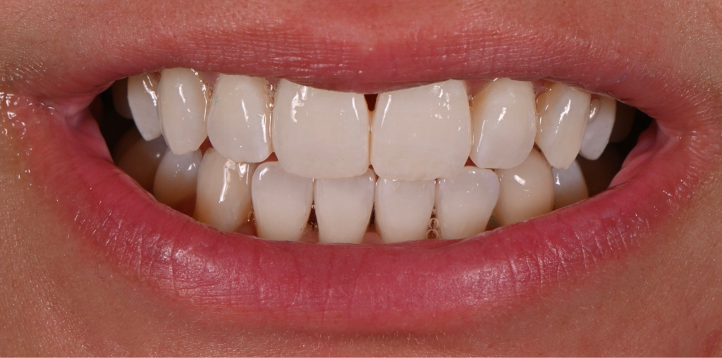 Teeth Whitening After