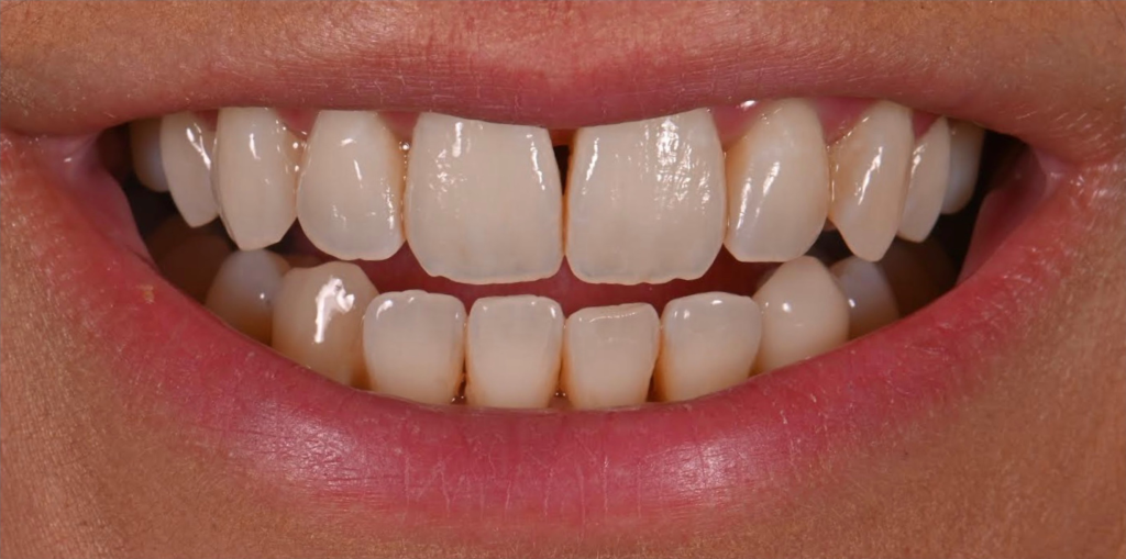 Teeth Whitening Before