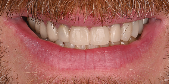 After dental treatment