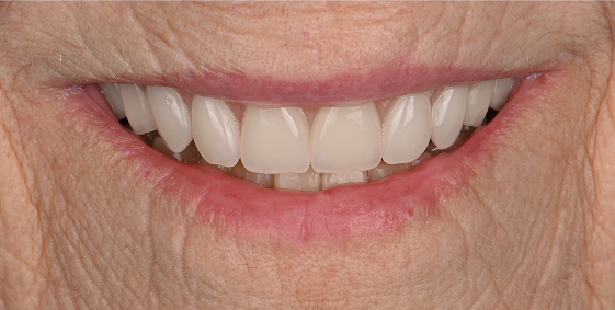 After dental treatment