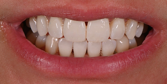After dental treatment