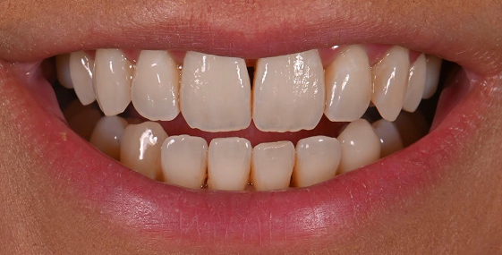 Before dental treatment