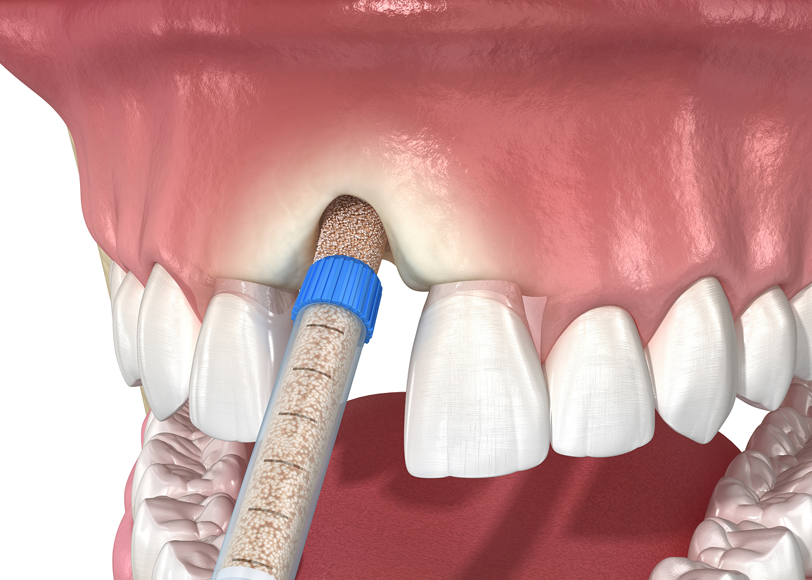 Bone Grafting Monroe Township, NJ