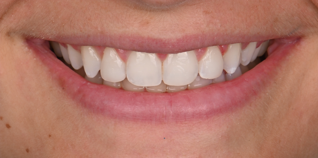Teeth Realignment After