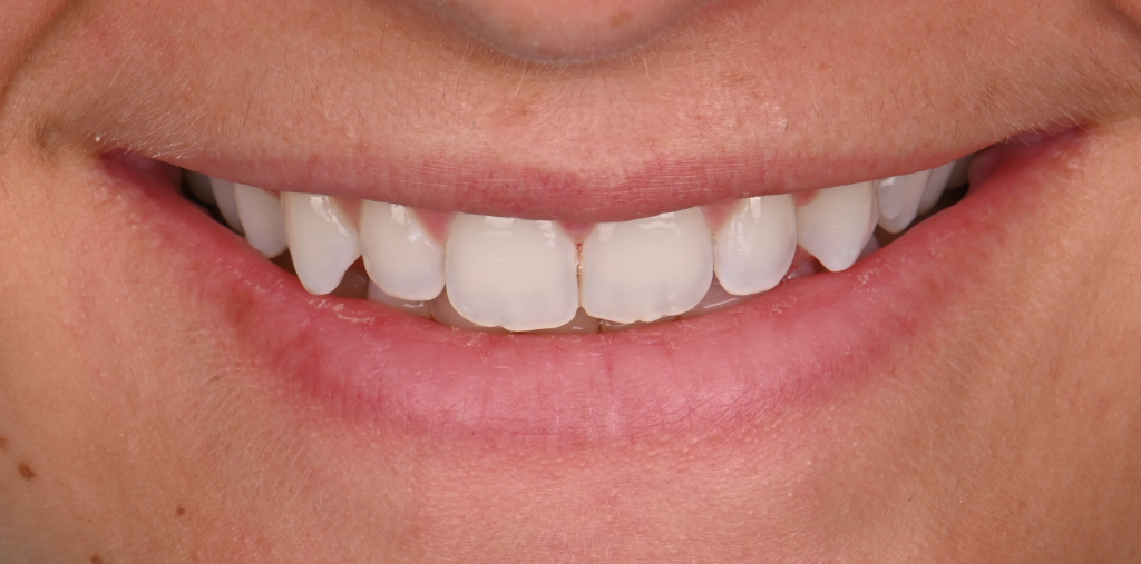 Teeth Realignment Before