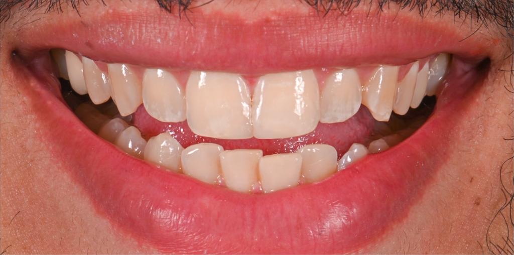 Anterior Veneers After