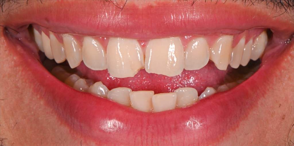Anterior Veneers Before