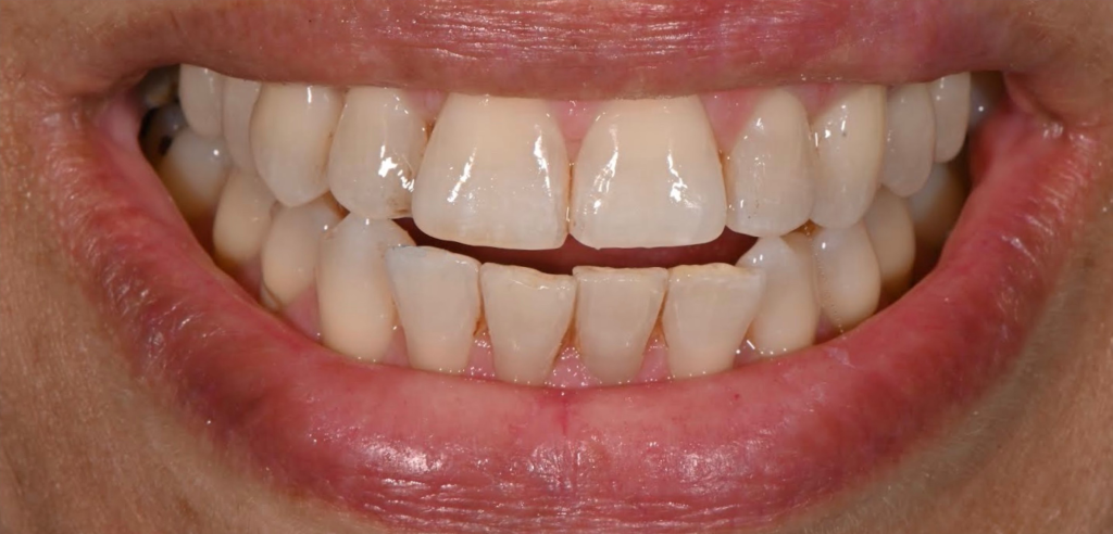 Complete Renewal After