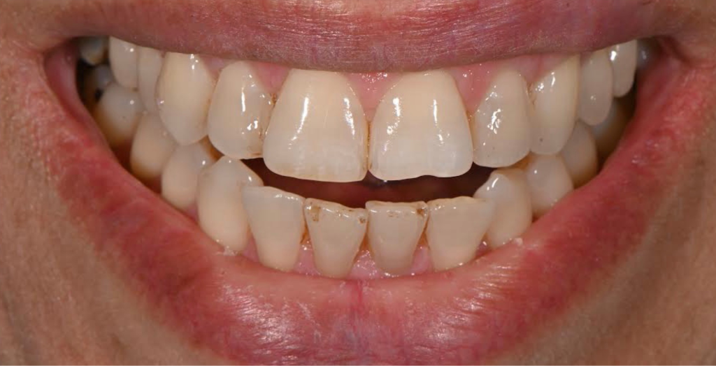 Complete Renewal Before