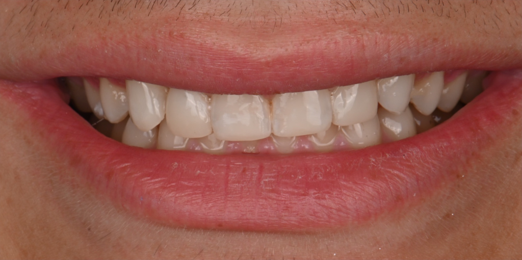 Full Arch Smile Design After