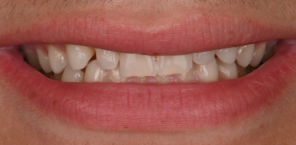 Full Arch Smile Design Before