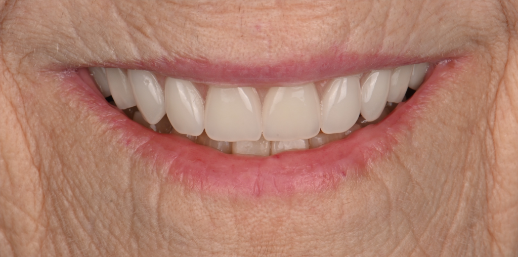 Crowns After