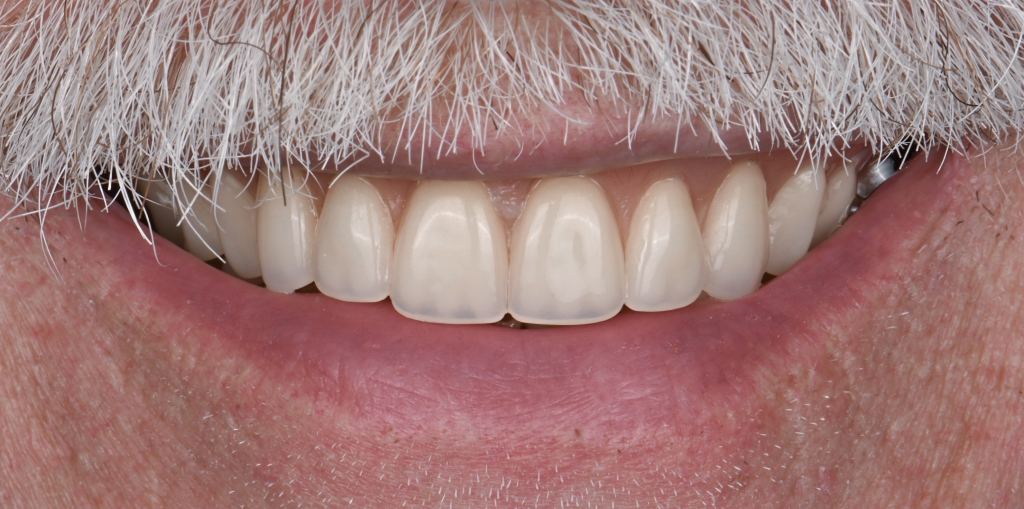 Implant Rehabilitation After