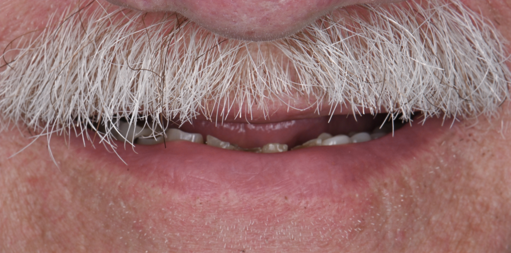 Implant Rehabilitation Before
