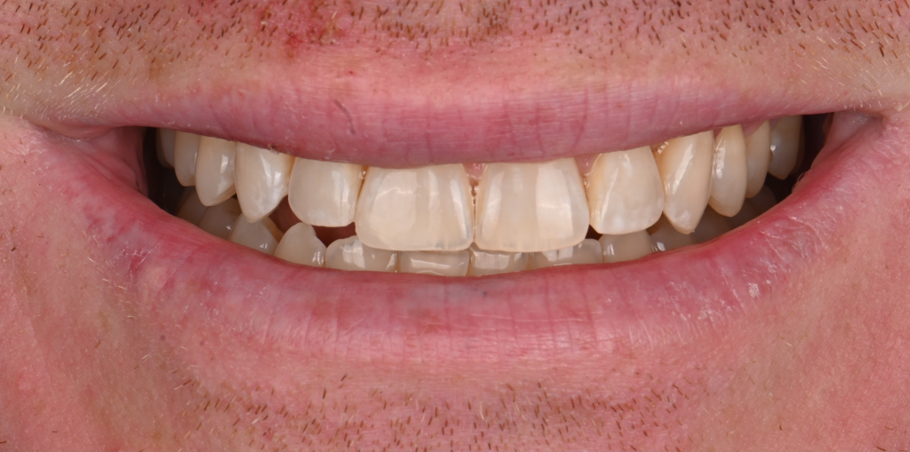Composite Bonding After
