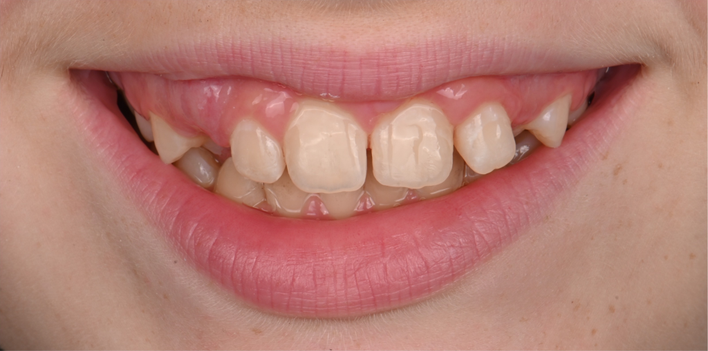 Smile Enhancement After