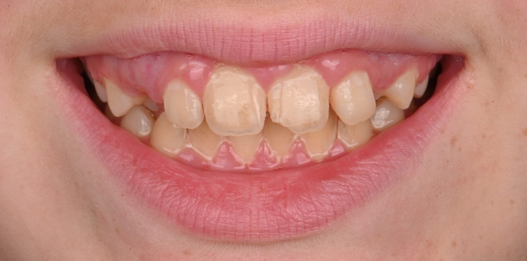 Smile Enhancement Before