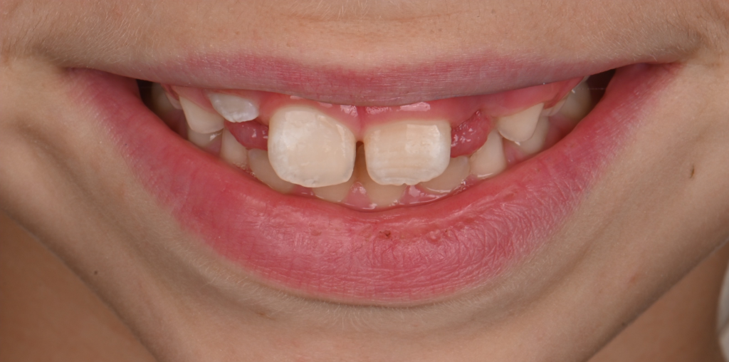 Implant Restoration After