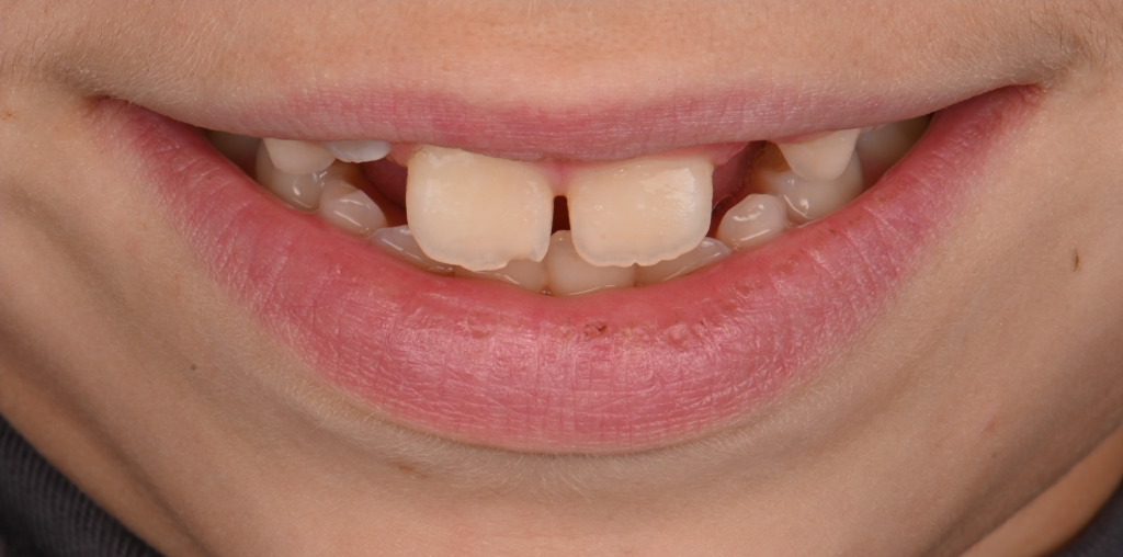 Implant Restoration Before