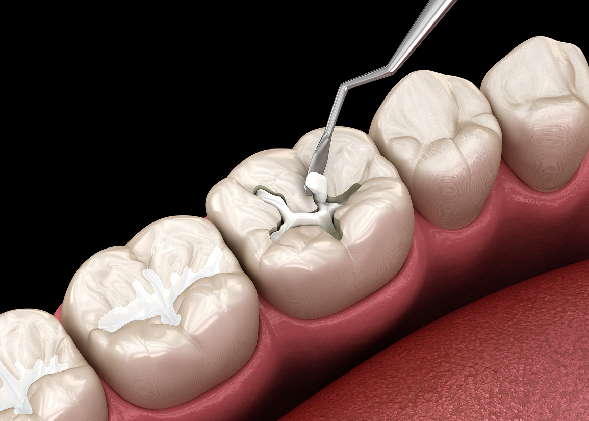 Composite Fillings Monroe Township, NJ