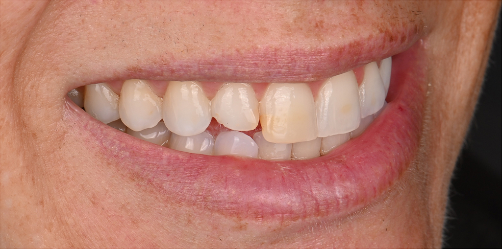 Composite Bonding Before