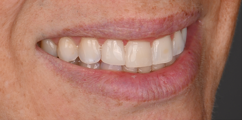 Composite Bonding After
