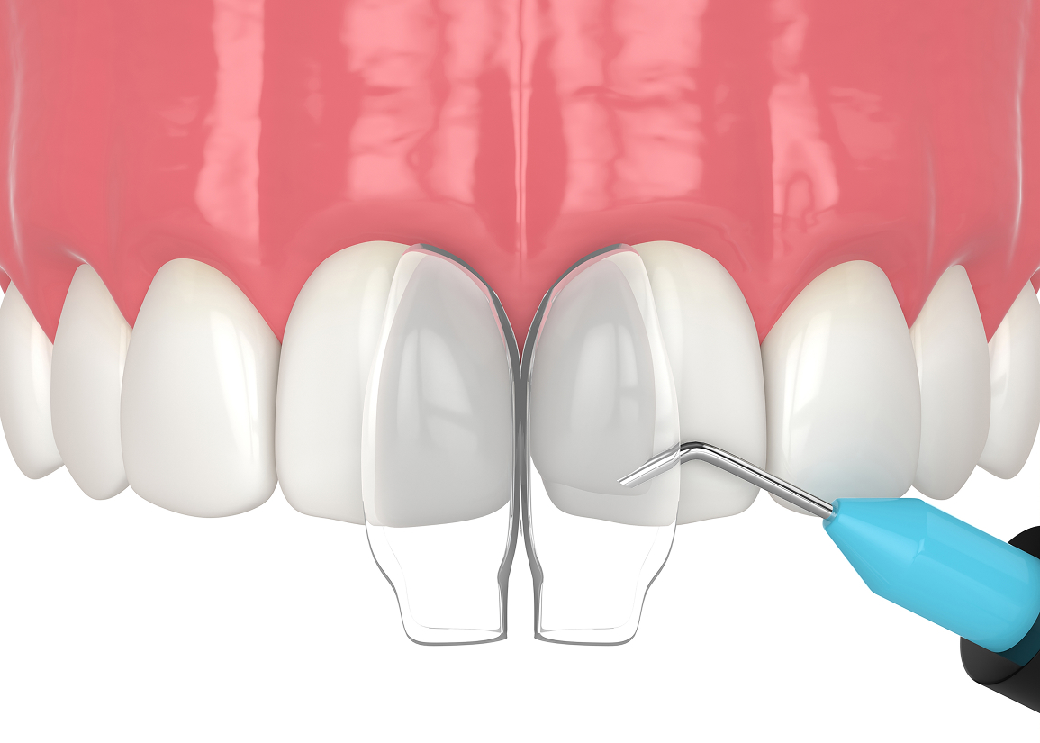 Dental Bonding Monroe Township, NJ