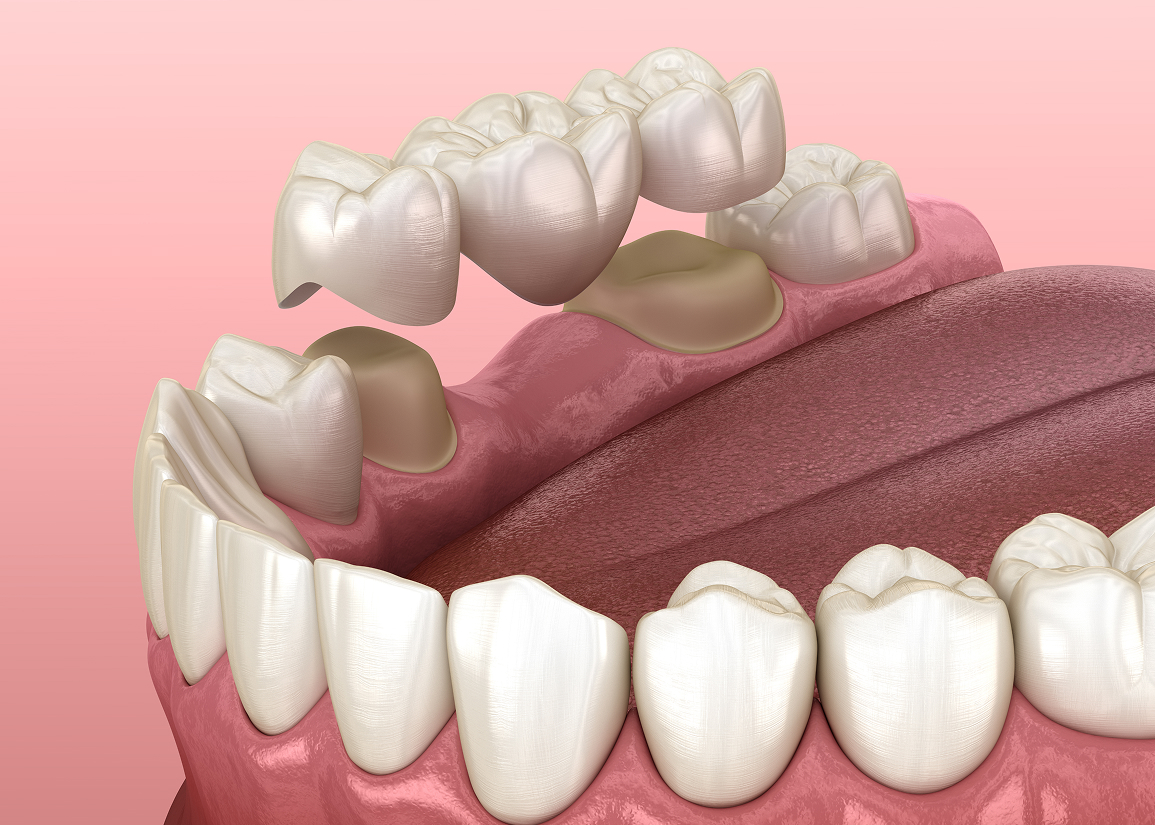 Dental Crowns and Bridges Monroe Township, NJ