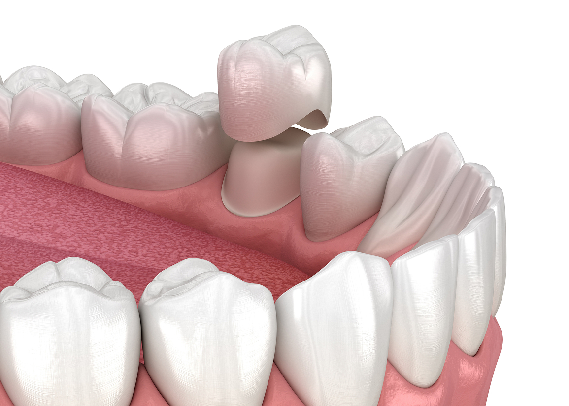 Dental Crowns Monroe Township, NJ