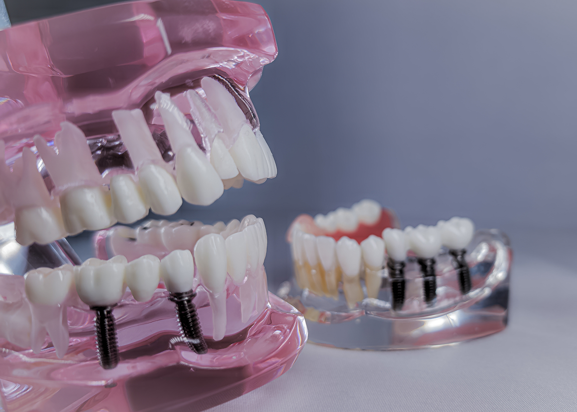 Dental Implant Services Monroe Township, NJ