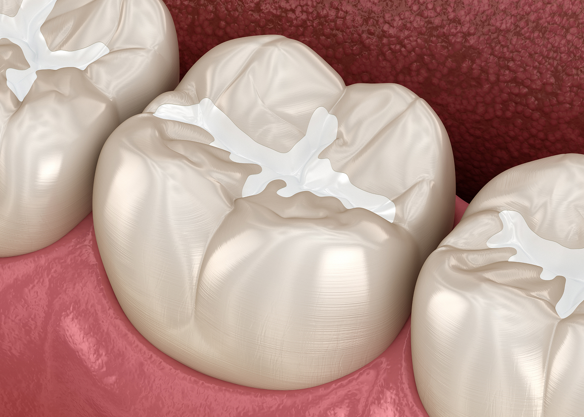 Dental Sealants Monroe Township, NJ