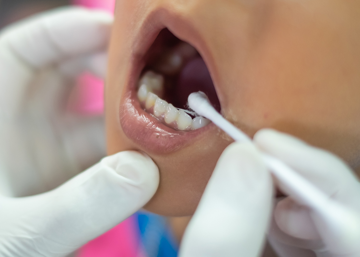 Fluoride Treatment Monroe Township, NJ