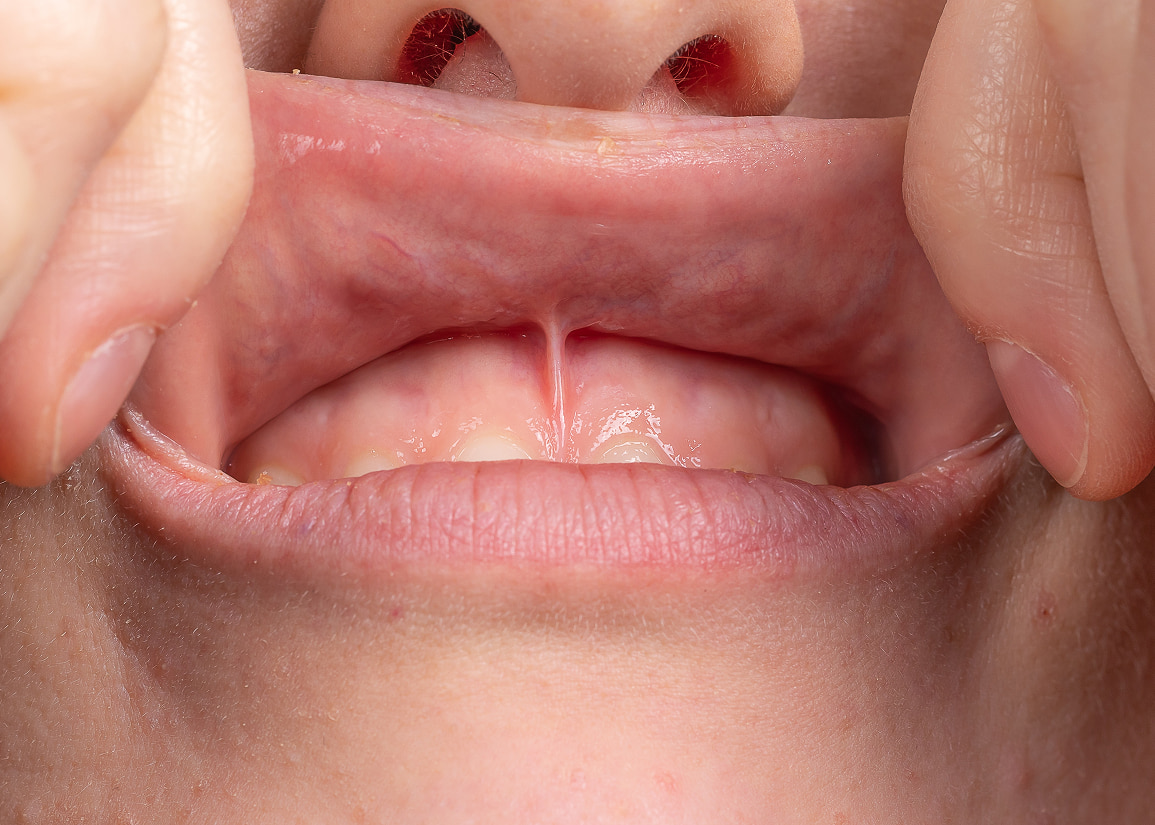 Frenectomy Monroe Township, NJ