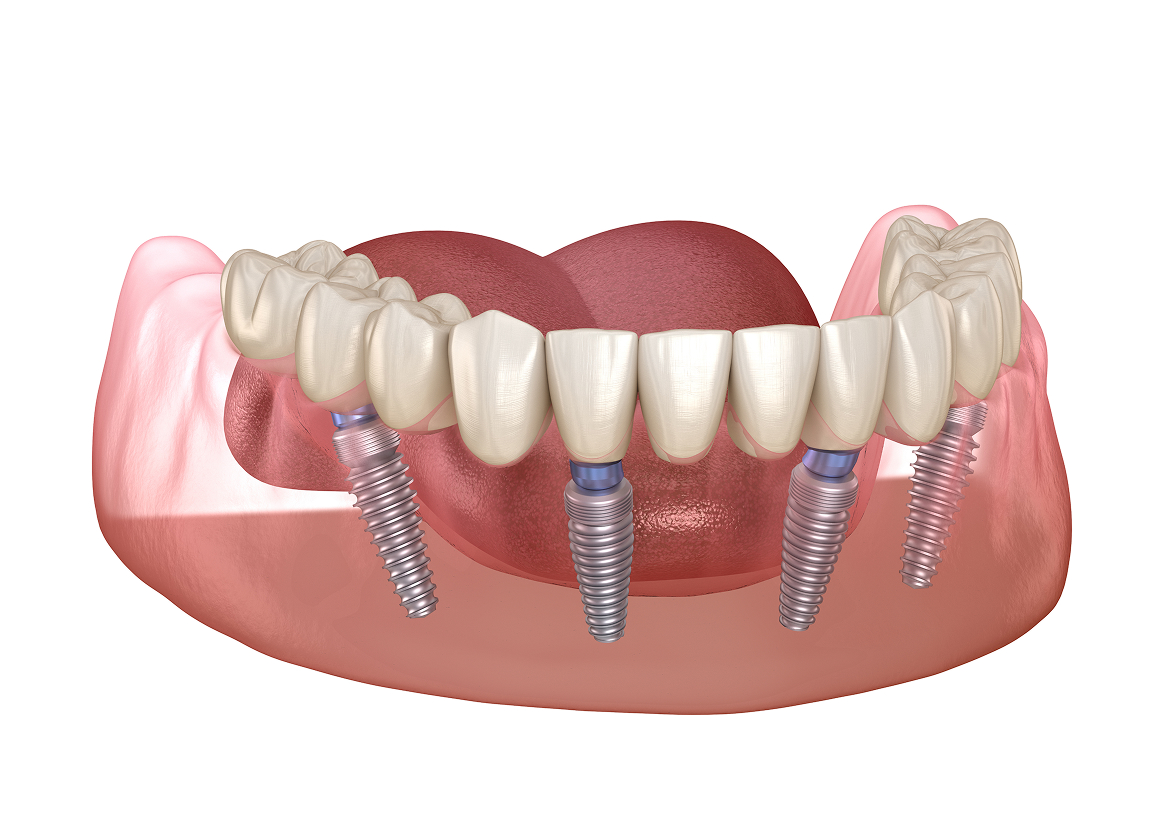 Full-Arch Dentistry Monroe Township, NJ