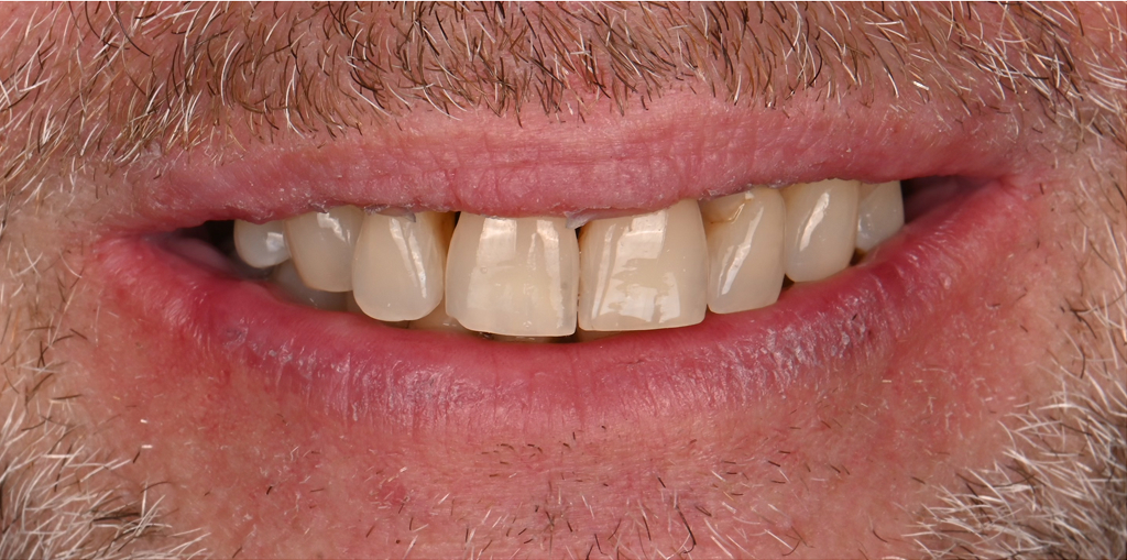 Implant Rehabilitation Before