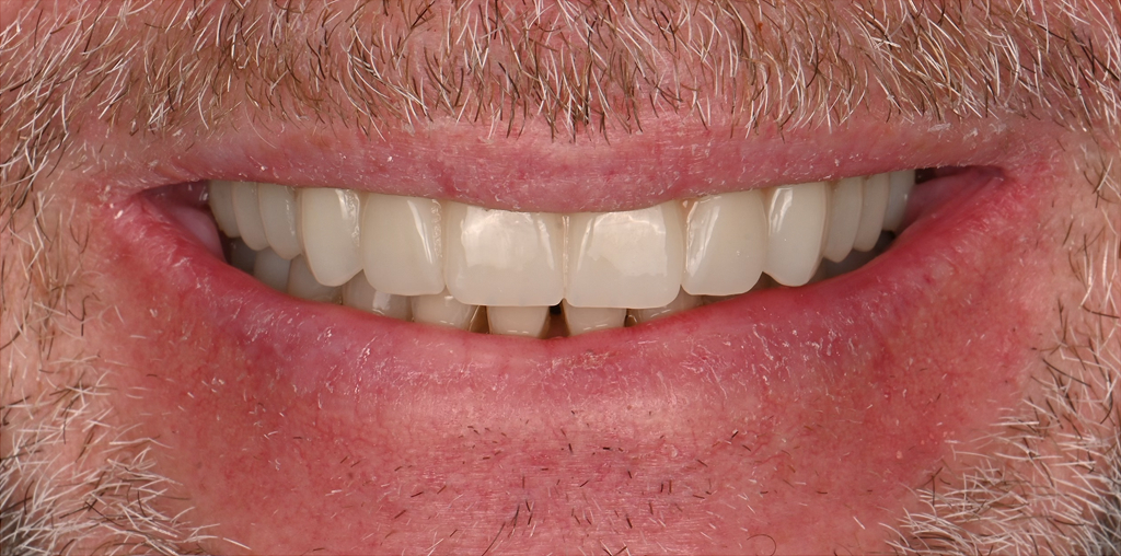 Implant Rehabilitation After