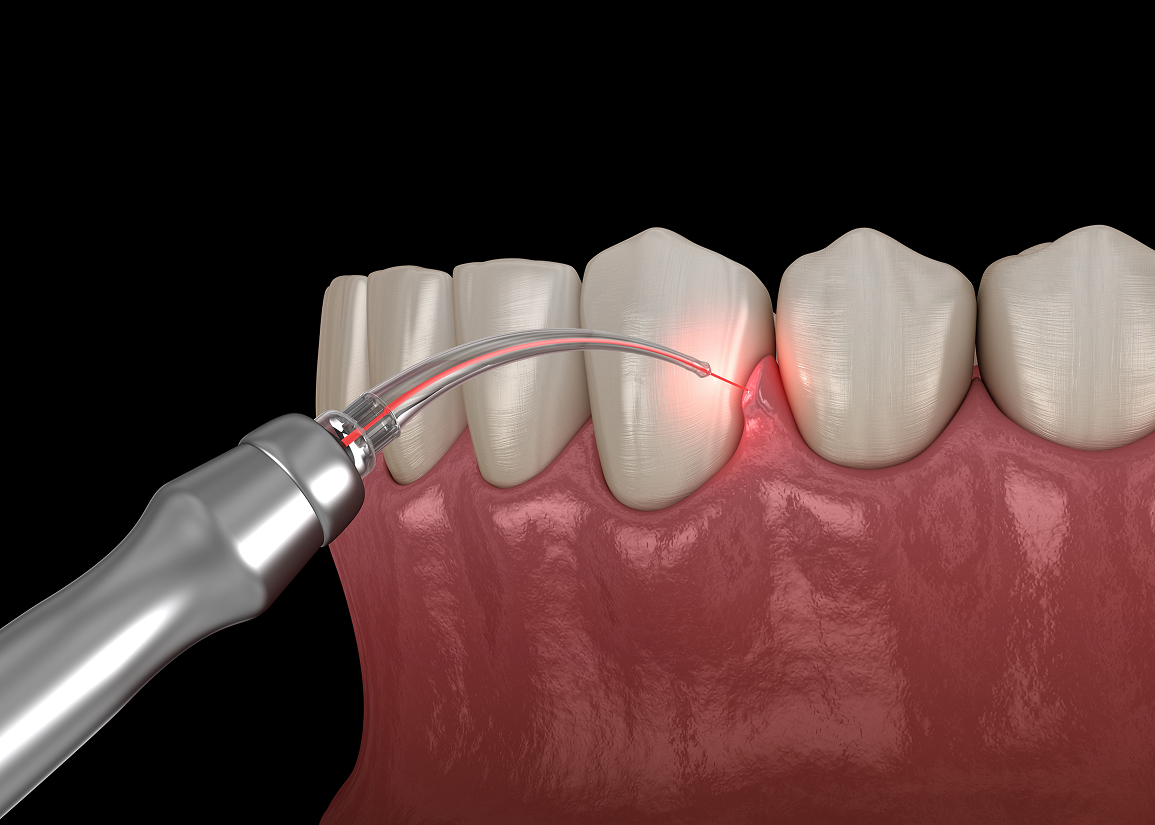 Periodontal Laser Dentistry Monroe Township, NJ