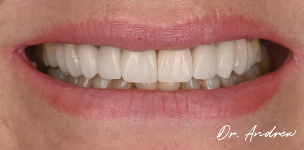 Porcelain Crowns and Veneers Case 2 After