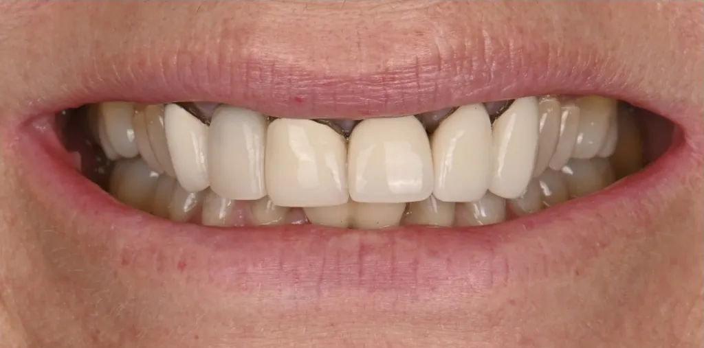 Porcelain Crowns and Veneers Case 2 Before