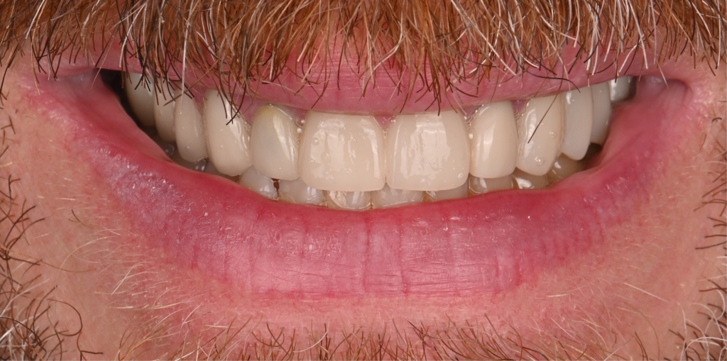 Porcelain Crowns and Veneers Case 3 After