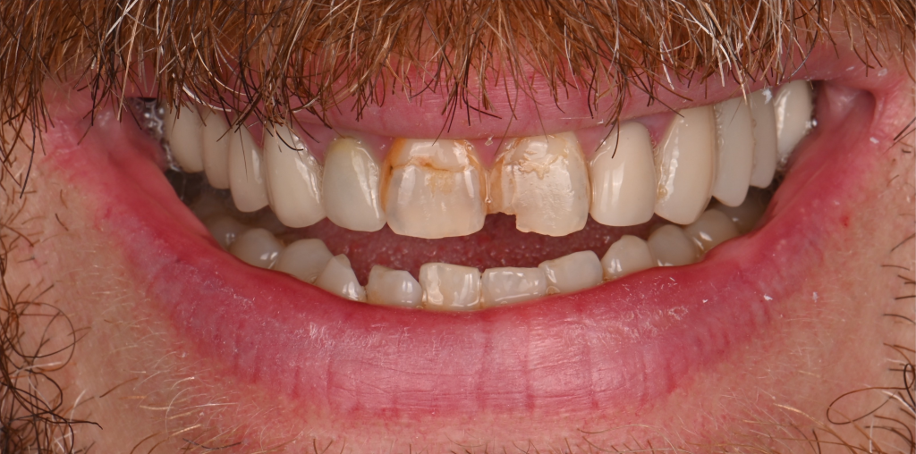 Porcelain Crowns and Veneers Case 3 Before
