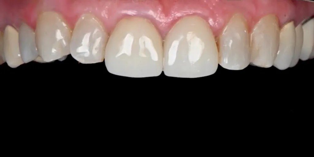 Porcelain Crowns and Veneers Case 4 Before
