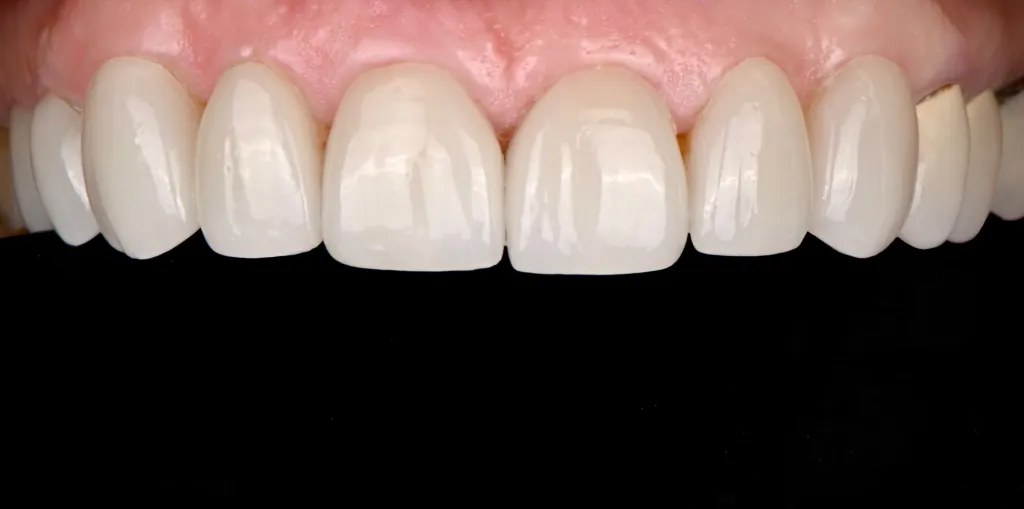 Porcelain Crowns and Veneers Case 4 After
