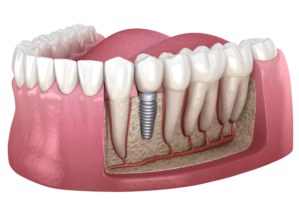 Single Tooth Implants Monroe Township, NJ