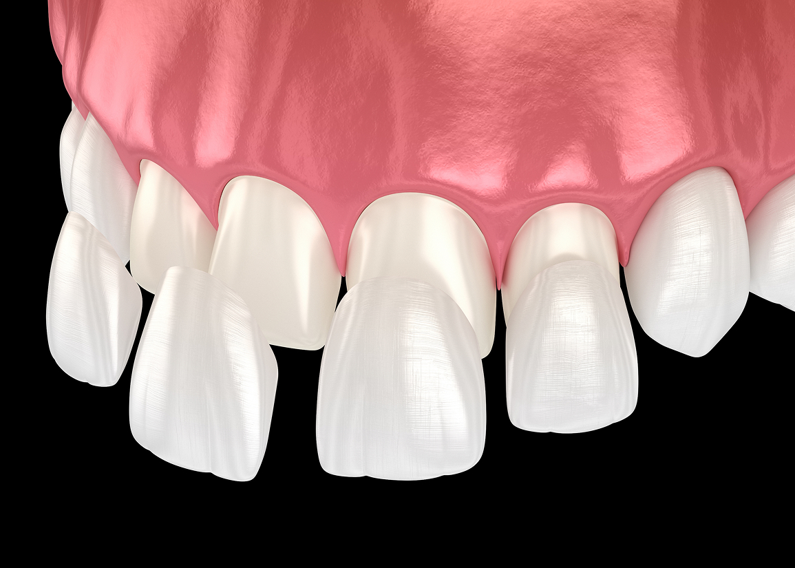 Dental Veneers Monroe Township, NJ
